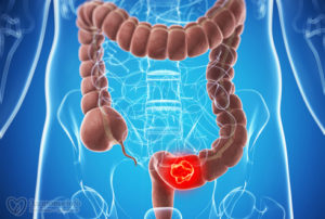 Cauzele cancerului intestinului, caracteristici clinice, tratament