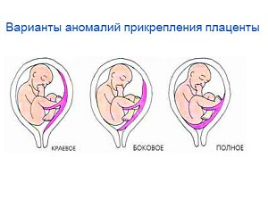 Amplasarea placentă în timpul sarcinii - opțiuni de normă