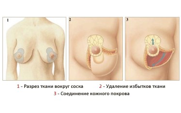 Reducere indicații mamara, contraindicații
