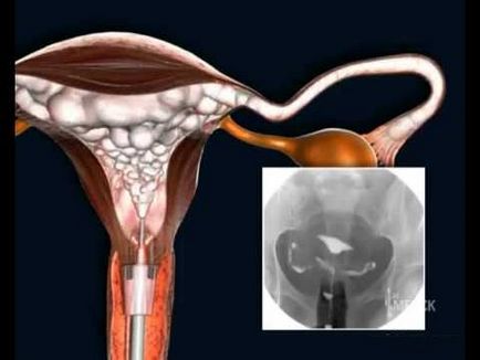Cu raze X a trompelor uterine consecințe potențiale, așa cum fac