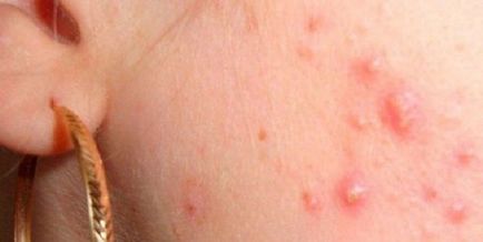 Cauzele roz de acnee, simptome și tratament