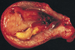 sarcomul uterin - simptome, prognostic, fotografie, etapa, tratament