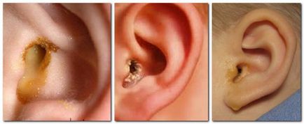 Sulf în urechile copilului este luat de ce fel încât să se elimine