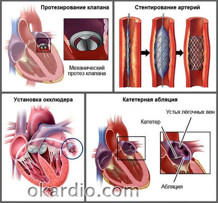 simptome insuficienta cardiaca, tratament, ceea ce este