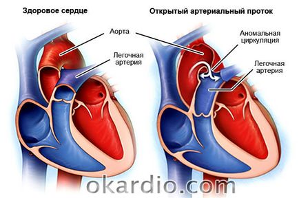 simptome insuficienta cardiaca, tratament, ceea ce este