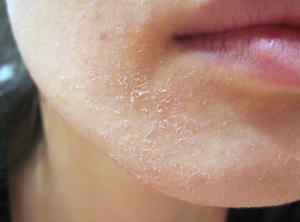 Descuamarea pielii cauze, simptome, tratamente, diagnostice (peeling) Descuamarea pielii cauze, simptome, tratamente, diagnostic