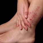 descuamarea pielii pe picioare și degetele de la picioare pentru a face cu peeling
