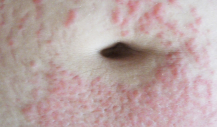 Erupții cutanate pe abdomen foto, motive, descrieri, boli de piele