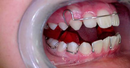 Parantezele pe dinți pentru copii și adulți - tipurile și caracteristici ale aplicației
