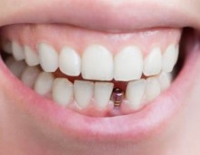 Parantezele pe dinți pentru copii și adulți - tipurile și caracteristici ale aplicației