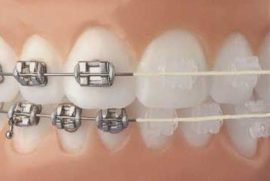Parantezele pe dinții de copii și adulți imagini - înainte și după, cât de mult sunt aparate dentare
