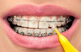 Parantezele pe dinții de copii și adulți imagini - înainte și după, cât de mult sunt aparate dentare