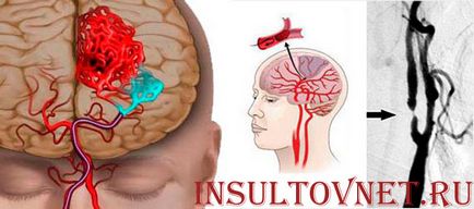 Moartea ca urmare a accident vascular cerebral - realitate sau speculații