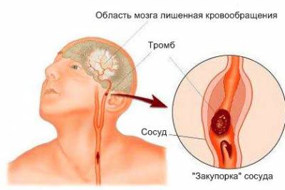 Tratamentul vasospasmul cerebral, simptome de vasospasm și vasoconstricție