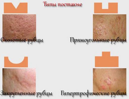 Remediu pentru acnee cicatrici (cicatrici) - cel mai bun acasă, de la pete, folk, eficient