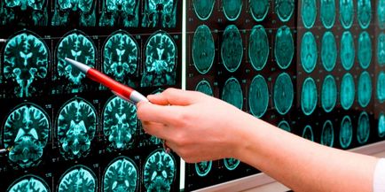 Stem accident vascular cerebral - ce este, simptomele, diagnosticul și tratamentul leziunilor capului trunchiului cerebral