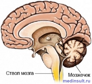 Stem cauze de accident vascular cerebral, perspectivele de recuperare