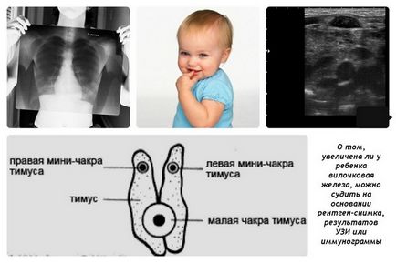 Thymomegalia - cauze, semne, simptome și tratament
