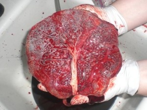 placenta subțire - fie că este periculos (subțire) Subțire placenta - fie că e periculos