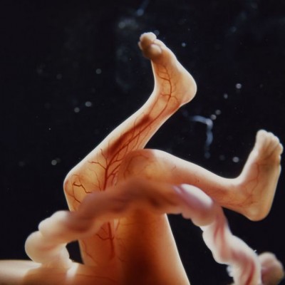 placenta subțire - fie că este periculos (periculoasă) Subțire placenta - fie că e periculos
