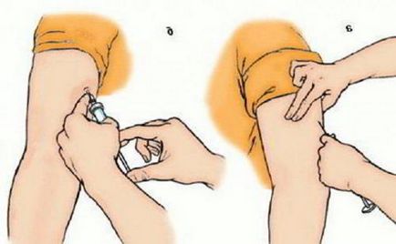 Injecțiile pentru tratamentul articulatiilor intramuscular ce medicamente sunt eficiente (tratament) Injecțiile pentru tratamentul articulațiilor intramuscular ceea ce medicamente sunt eficiente