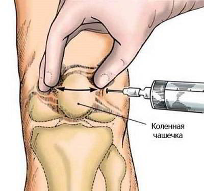 Injecțiile pentru tratamentul articulatiilor intramuscular ce medicamente sunt eficiente (tratament) Injecțiile pentru tratamentul articulațiilor intramuscular ceea ce medicamente sunt eficiente