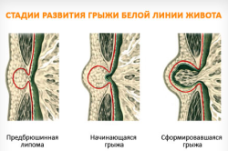 cauze hernie strangulată, simptome, tratament