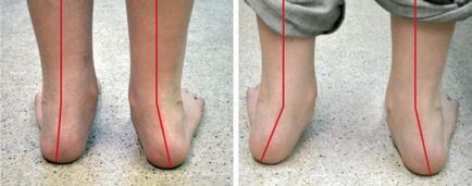 Valgus picior deformare la copii fotografie, tratament, cauze, simptome