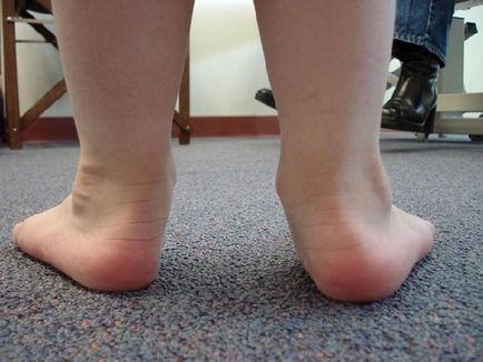 Valgus picior deformare la copii fotografie, tratament, cauze, simptome