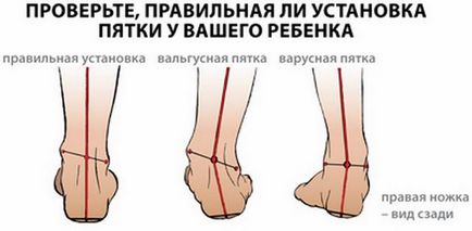 Valgus picior deformare la copii fotografie, tratament, cauze, simptome
