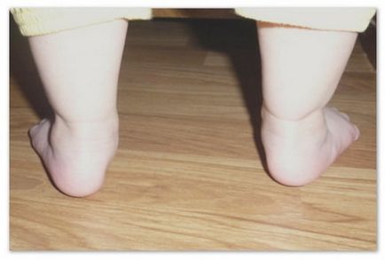 Valgus picior deformare la copii fotografie, tratament, cauze, simptome