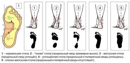 Valgus picior deformare în patologia copii fotografie