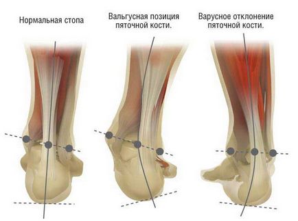 Valgus picior deformare în patologia copii fotografie