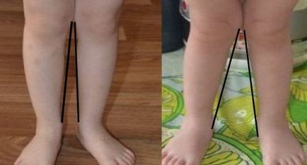Valgus picior deformare în patologia copii fotografie