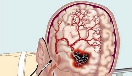 Vasospasm vaselor cerebrale - este o boală gravă, uflebologa