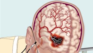 vasospasm cerebrovasculare (cerebral), simptome, tratamentul, prevenirea