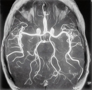 vasospasm cerebrovasculare (cerebral), simptome, tratamentul, prevenirea