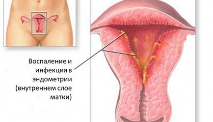 Alocarea sangerari intermenstruale intre perioade, aciclic, roșii din sânge