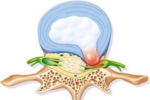 Tipuri de foraminal hernie de disc, simptomele sale, tratamentul, în special apariție