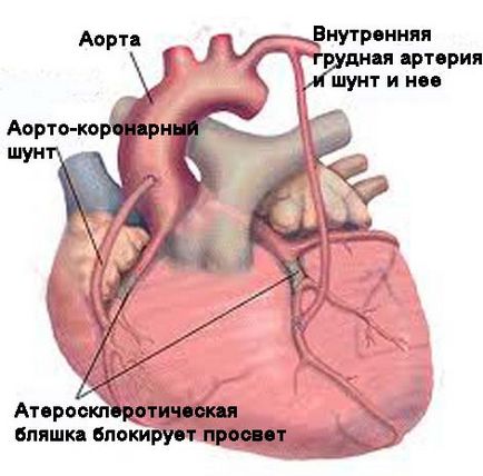 Tipuri de tratament chirurgical al infarctului miocardic