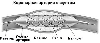 Tipuri de tratament chirurgical al infarctului miocardic