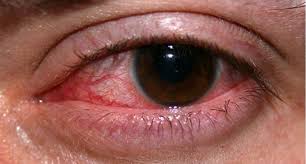 Infecțiile virale ale simptomelor oculare si tratament