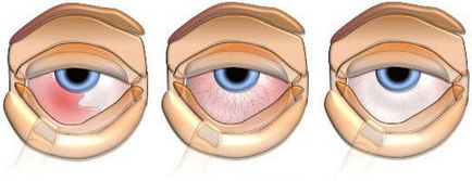 Infecțiile virale ale simptomelor oculare si tratament