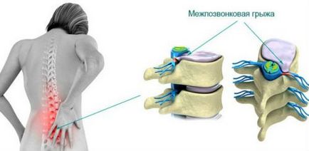 Restaurarea discurilor intervertebrale și a cartilajului la nivelul coloanei vertebrale