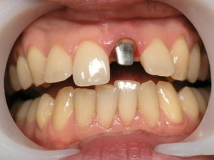 Restaurarea dinte frontal rupt