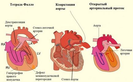 Bolile cardiace congenitale - cauze, simptome și tratament