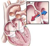 Bolile cardiace congenitale - cauze, simptome, diagnostic și tratament