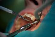corectia chirurgicala a indicației mușcătură, procedura operației (corectarea ocluziei recenzii chirurgical) corectia chirurgicala a citirilor muscatura, operație conduita
