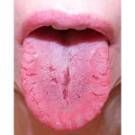 Ulcerele asupra cauzelor limbii și tratament, fotografii