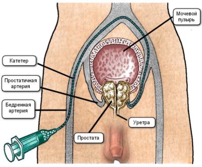 Boli ale glandei prostatei la bărbați de prostată diferite diagnostice și cauze comune